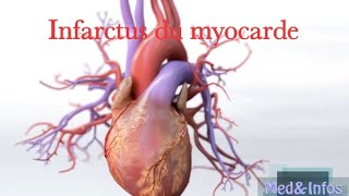 Infarctus du myocardemyocardial infarction [upl. by Imoan832]