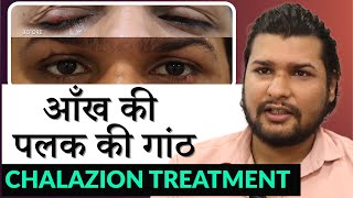 How To Get Rid Of Stye Fast 🔴 Chalazion vs Stye Treatment [upl. by Nomi]