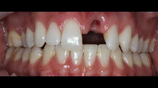 Front tooth extraction with immediate implant and temporary [upl. by Ylro]