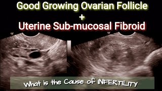 Ultrasound Good Ovarian Follicle at 9th Day  Uterine Submucosal Fibroid [upl. by Kaiulani]