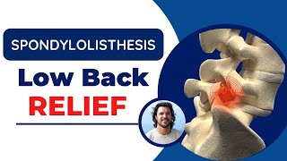 Spondylolisthesis Back Pain Relief Exercises and Adjustments [upl. by Orsino]