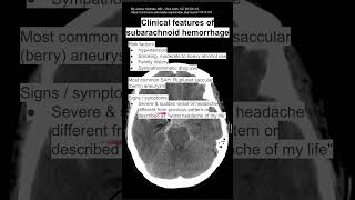 Clinical features of subarachnoid hemorrhage [upl. by Bainbridge853]