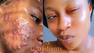 In 3 DAYS  Remove DARK SPOTS BLACK SPOTS amp ACNE SCARS  Anaysa [upl. by Enyala]