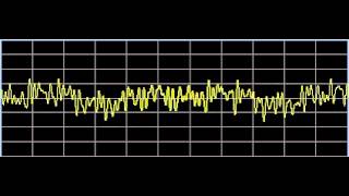 Eyelid Droop Ptosis  Rife Frequencies [upl. by Rafaelle]