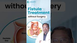 Fistula हो गया है Silicea किस लक्षण पर देना चाहिए  Fistula ki Best Homeopathic Medicine [upl. by Quintin]