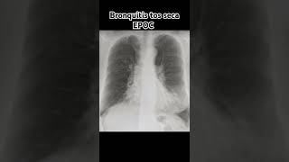 BRONQUITIS TOS SECA EPOC [upl. by Suoinuj232]