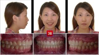 Correction of Skeletal Class ll Malocclusion｜【Chris Chang Ortho】CC423 [upl. by Ahsiek]