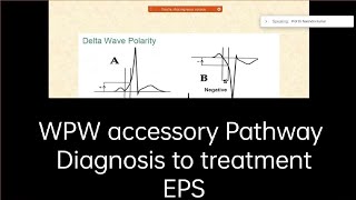 Wolff Parkinson white syndrome Accessory pathway mediated tachycardia AVRT ablation wpw [upl. by Noreht]