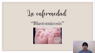 Blastomyces Dermatitidis Blastomicosis [upl. by Agretha]