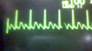 ECG Video Atrial Flutter [upl. by Jorgensen]