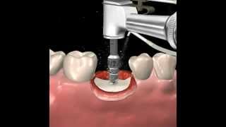 Placing Implant Abutments [upl. by Bartlet796]