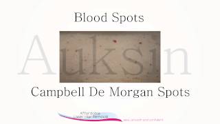 How To Get Rid Of Blood Spots Also Known as Campbell De Morgan Spots [upl. by Yduj848]