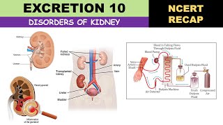 Excretion 10  Disorders of Excretory System  Uremia  Hemodialysis  Glomerulonephritis  Calculi [upl. by Morna]