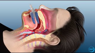 flexTAP Oral Appliance for Sleep Apnea How Does It Work [upl. by Larrej]