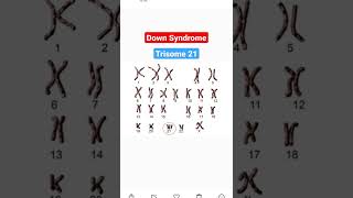 Down Syndrome upsc genetics trisomia21 trisomy trisomy21 personwithdisability india shorts [upl. by Eirak85]