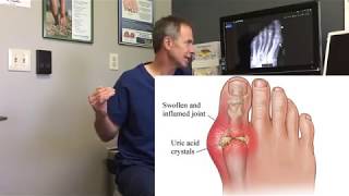 Gout – Symptoms and Treatment Options Part 1 [upl. by Albright]