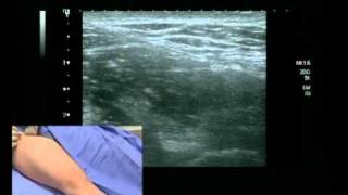 Femoral Nerve Block ultrasound guided [upl. by Trevah]