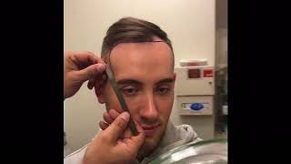 Neograft Hair Transplant Procedure  Part 2  Dr David P Rapaport NYC [upl. by Iy]