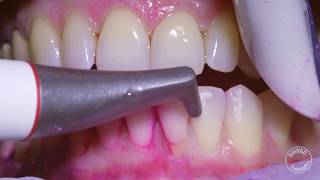 How teeth should be cleaned at the Dentist  Hygienist [upl. by Drhcir]