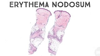 Erythema nodosum panniculitis subcutaneous nodules fat necrosis dermatology pathology dermpath [upl. by Lleret374]