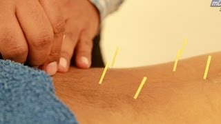 HINDI Acupuncture Treatment Demo [upl. by Enneiluj]