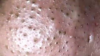 Blackheads amp Whiteheads Satisfying Removal 0004 [upl. by Eilrebmik]