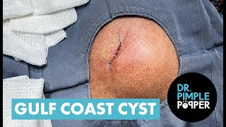 Dr Pimple Popper Opens The Gulf Coast Cyst [upl. by Shreve]