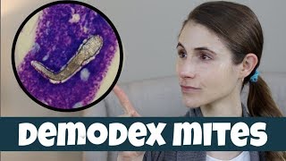 DEMODEX MITES ON YOUR SKIN DR DRAY [upl. by Bittner156]