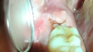 Painful swollen gum around wisdom tooth  molar Pericoronitis  Cure  Treatment [upl. by Atinram]