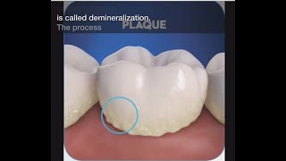 Stage 1 of Tooth Decay Demineralization [upl. by Eeuqram476]