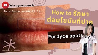 How to รักษาต่อมไขมันจุดขาวที่ปาก Fordyce spots  Derm Guide เดอะซีรี่ย์หมอผิวหนัง EP11 [upl. by Reeves290]