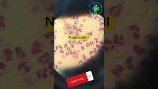 High neutrophil count in peripheral smear  neutrophils  CBC  Causes of Neutrophilia  hematology [upl. by Ylloj]