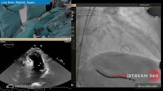 EchocardiographyGuided Alcohol Septal Ablation [upl. by Ahsinyar]