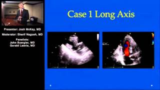 Alcohol Septal Ablation for Hypertrophic Obstructive Cardiomyopathy Panel Discussion [upl. by Assirod56]