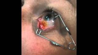 Eye Injection Procedure [upl. by Ddat]