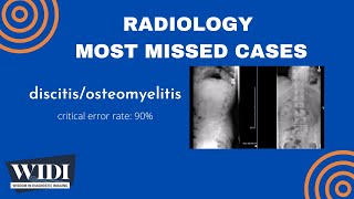 Most Missed Cases DiscitisOsteomyelitis [upl. by Joyann449]