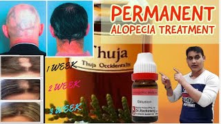 5 Best Homeopathic Medicine For Alopecia Areata Permanent Treatment  Regrow New Hair [upl. by Rosette]