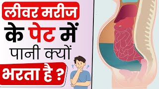 जलोदर Ascites क्या होता है  Ascites Causes Symptoms and Treatment  Bharat Homeopathy [upl. by Aneba156]