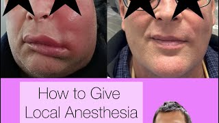 How to Give Local Anesthesia for this Abscess [upl. by Neirad]