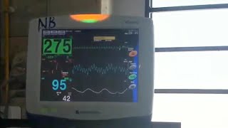 心電図モニター 実際の測定 Ventricular Tachycardia VT心室頻拍 NIHONKOHDEN Vismo [upl. by Coplin]