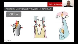 Princípios da Exodontia  PARTE 2 [upl. by Tice]