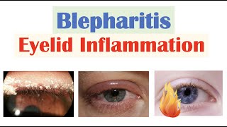 Blepharitis Eyelid Inflammation  Causes Risk Factors Signs amp Symptoms Diagnosis Treatment [upl. by Buffo]