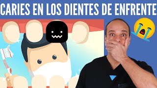 CARIES en los DIENTES de ENFRENTE 😱 2 Técnicas SEGURAS para Evitarlas GARANTIZADO 💪 [upl. by Gosnell225]