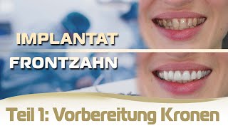 Implantat einsetzen Frontzahn Ablauf Teil 1  Vorbereitung für die Kronen und provisorische Brücke [upl. by Pomfret]