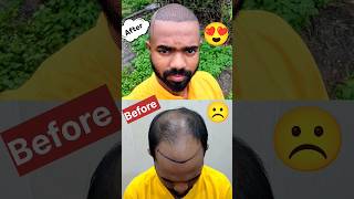 One week journey of Hair Transplant 😍😘❤️ 5M Views 🫶 Thank You Bhai hairtransplant D2LifeVlogging [upl. by Onibag]