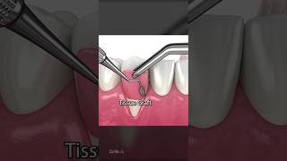 Soft Tissue Graft Surgery for Receding Gums [upl. by Ttehr]