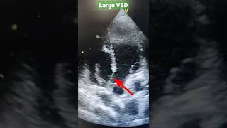 Perimembranous VSD Echo Ventricular septal defect shorts [upl. by Joiner778]