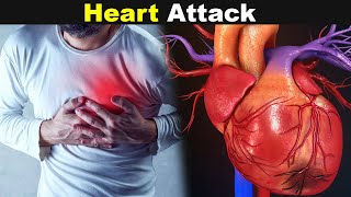 Heart Attack Mayocardial Infarction  SymptomsCauses And Treatments UrduHindi [upl. by Niobe]