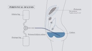 Understanding peritoneal dialysis [upl. by Hermon909]