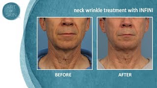 Neck wrinkle treatment with radiofrequency microneedling [upl. by Deeas]